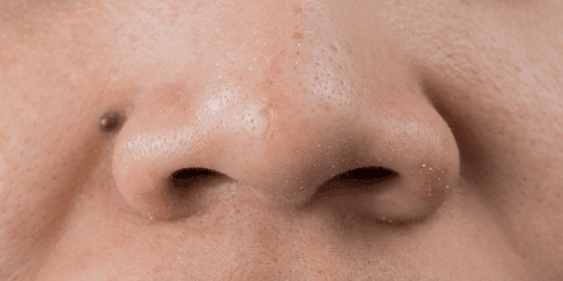 Remove black and whiteheads