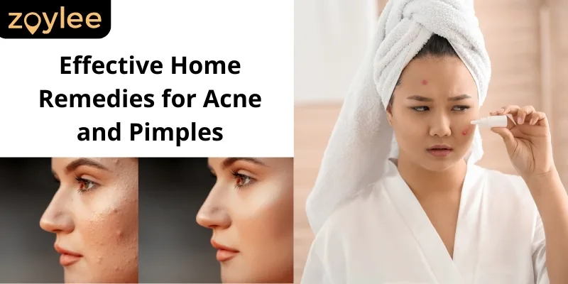 Home Remedies for Pimples