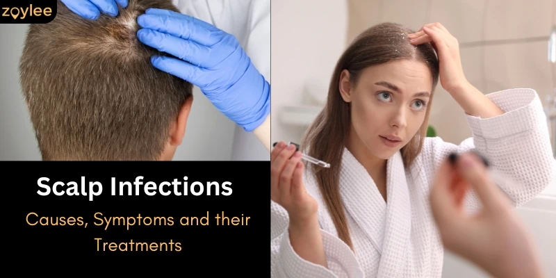 Scalp Infections Causes, Symptoms and their Treatments