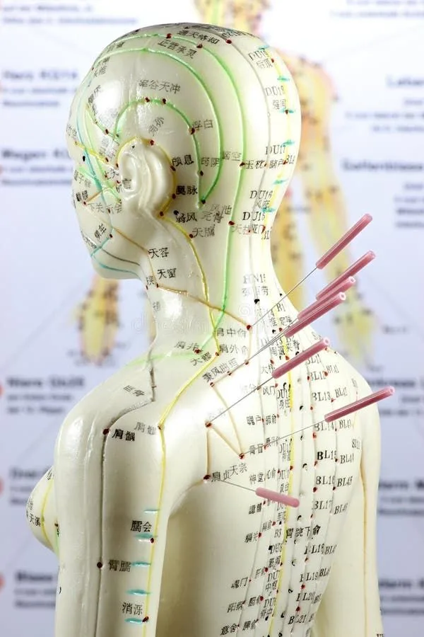 Acupuncture